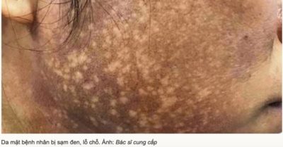 Mặt như bánh đa vừng vì tin lời quảng cáo làm đẹp biến ‘da cóc’ thành ‘bạch tuyết’