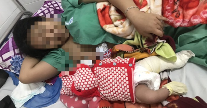 Bé trai sơ sinh bị gãy xương đùi khi sinh mổ