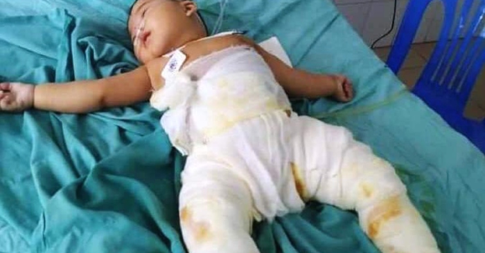 Cháu Linh ngã vào chậu than, đang điều trị tại bệnh viện.