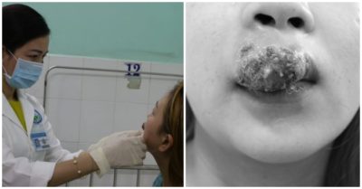 Cô gái 27 tuổi chảy mủ, sưng phù môi sau khi bỏ 2 triệu đồng làm đẹp ăn Tết