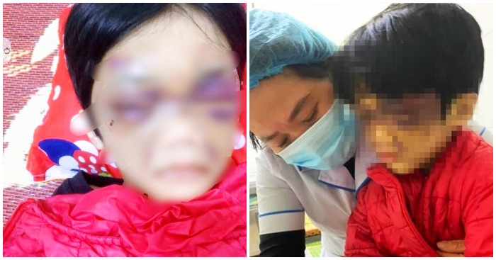 Cháu V.N.P.C. (6 tuổi) bị mẹ bạo hành dã man (ảnh chụp màn hình báo Tuổi Trẻ).