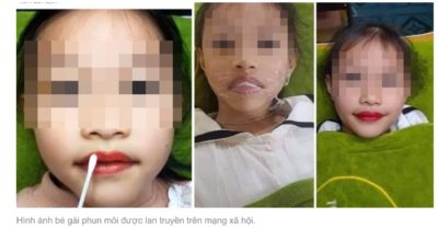 Thẩm mỹ viện ở Thanh Hóa phun môi cho bé gái 5 tuổi