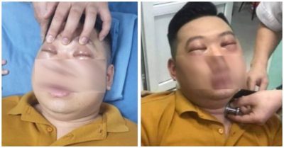 Phú Thọ: Nam thanh niên nguy kịch sau khi thái một củ hành