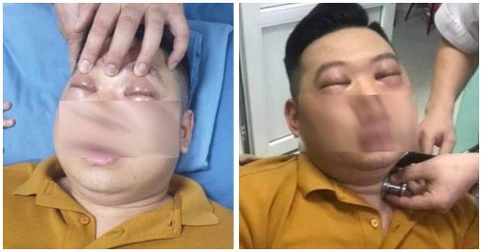 Bệnh nhân bị sốc phản vệ sau khi cắt hành.