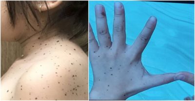 Bệnh nhi mắc hội chứng da báo đầu tiên tại Việt Nam