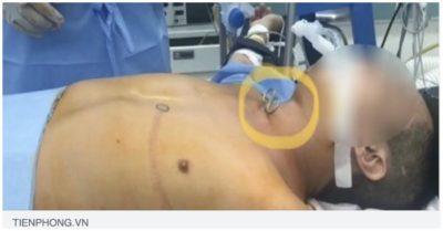 Cán bộ xã dùng kéo cắt vào cổ khi đang làm việc trong khu cách ly phòng dịch Covid-19