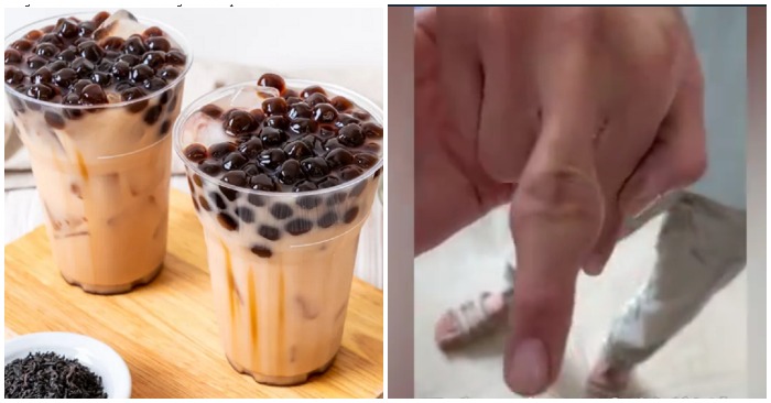 ngón tay sưng
