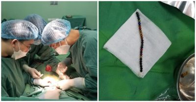 Bé trai 3 tuổi bị thủng ruột vì nuốt 25 viên bi nam châm vào bụng