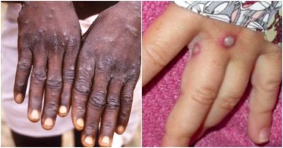 Cập nhật tối 25/5: Giám sát người nhập cảnh nghi bệnh đậu mùa khỉ; Học phí đại học tăng vọt trong năm tới